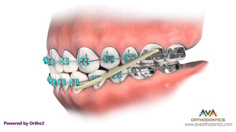 underbite metal bracket rubber bands not braces|rubber bands for underbite.